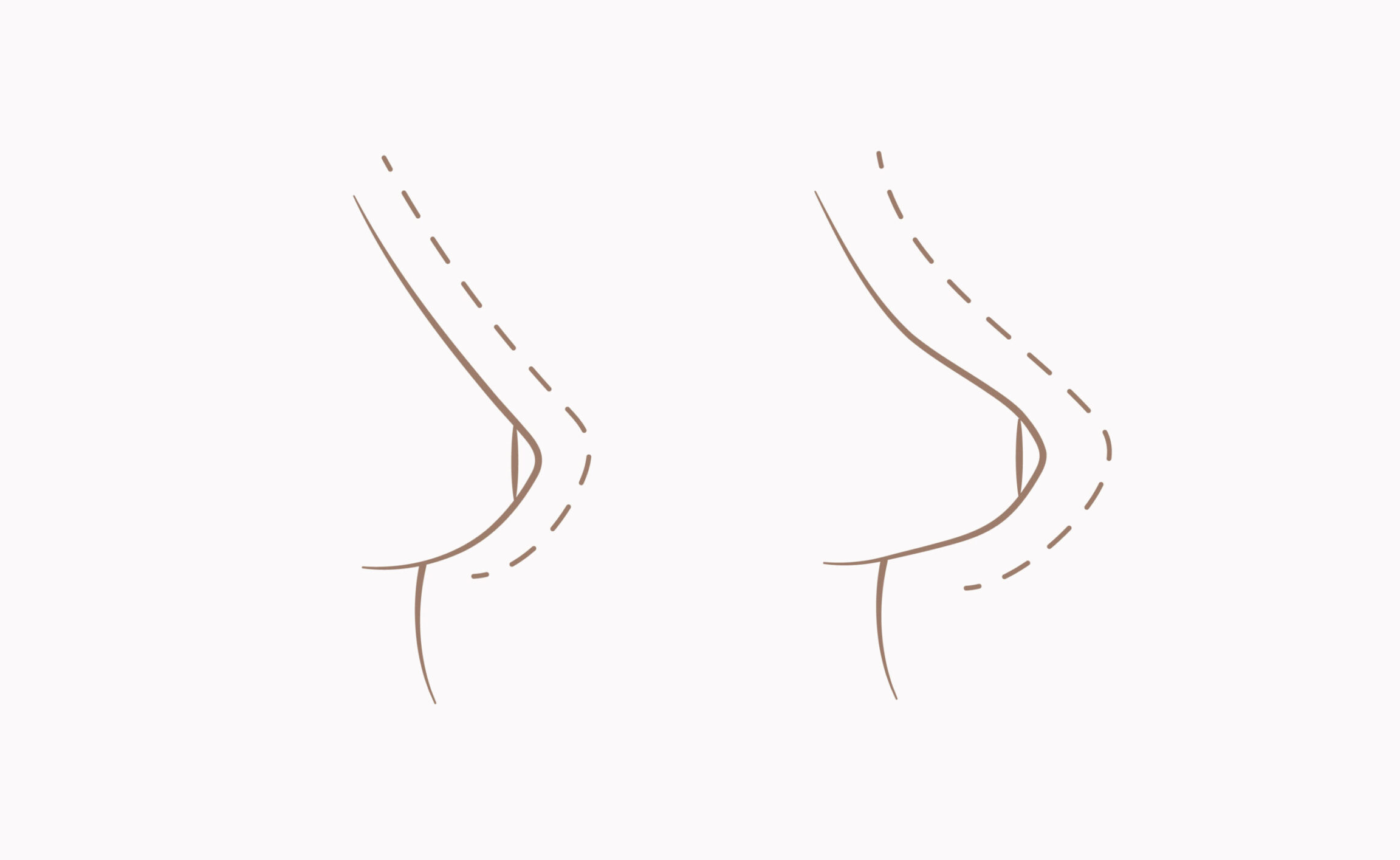 Understanding Tubular Breasts