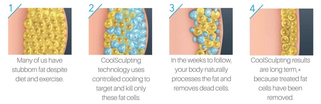 Inforgraphic of how CoolSculpting works
