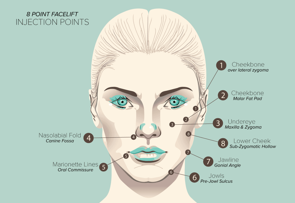 8 Point Facelift Injection Points