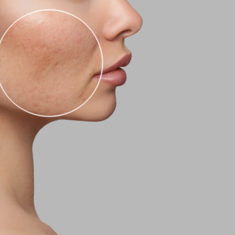 A photo that highlights the cheek of a patient who recently underwent the acne bootcamp