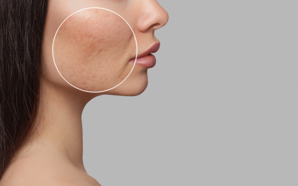 How to treat adult acne