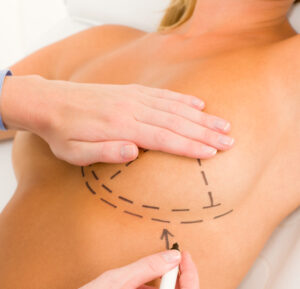 Breast Lift With Augmentation - Donaldson Plastic Surgery