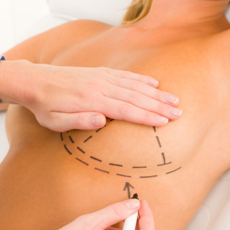 Is a Breast Lift Safe with Augmentation?