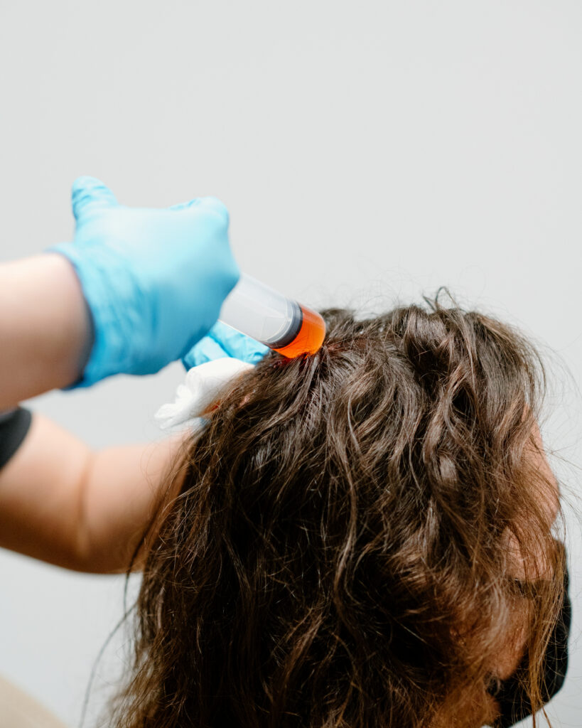 What Does A PRP Hair Restoration Treatment Look Like