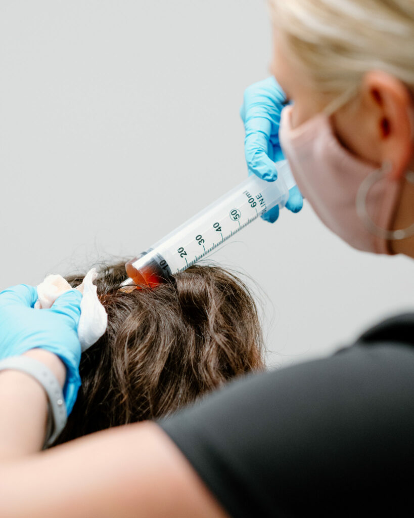 PRP Hair Loss Injection 