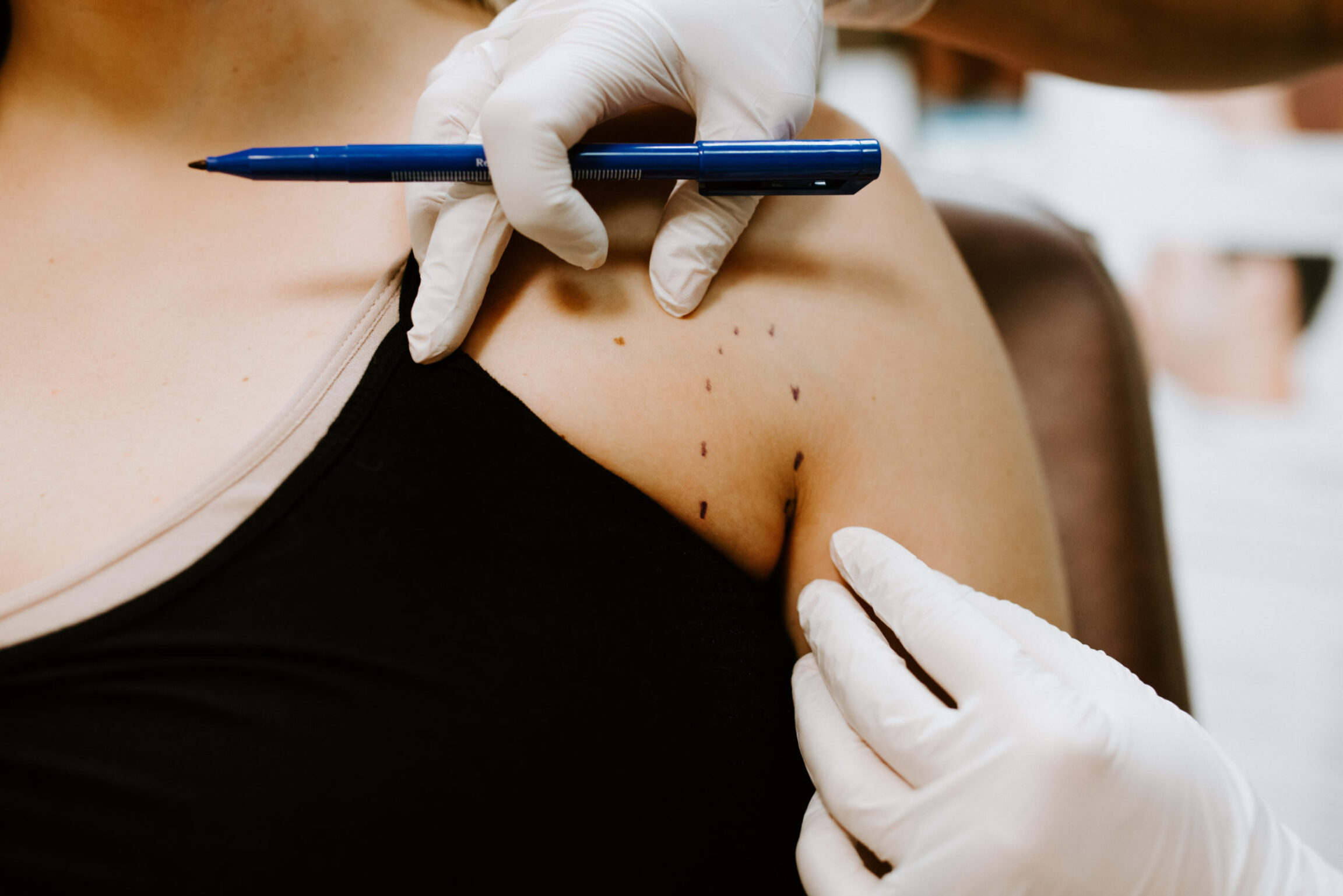 Preparing a patient for Kybella injections
