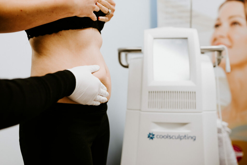 Coolsculpting in Columbus Ohio