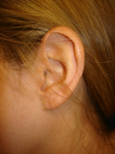 Surgically Repaired Earlobe