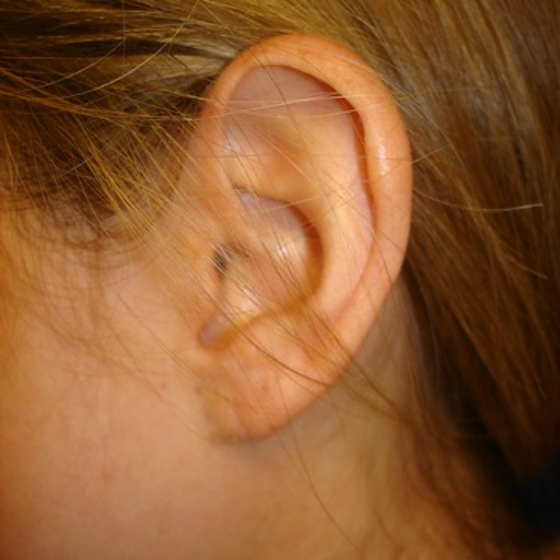 Earlobe Repair for Stretched or Split Piercings