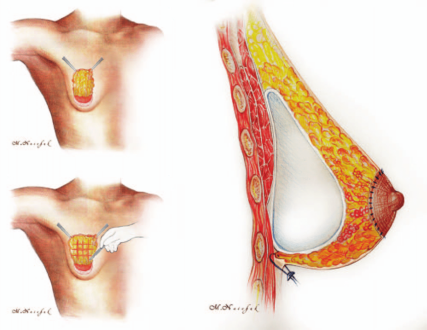Breast Augmentation Surgery For Tubular Breasts