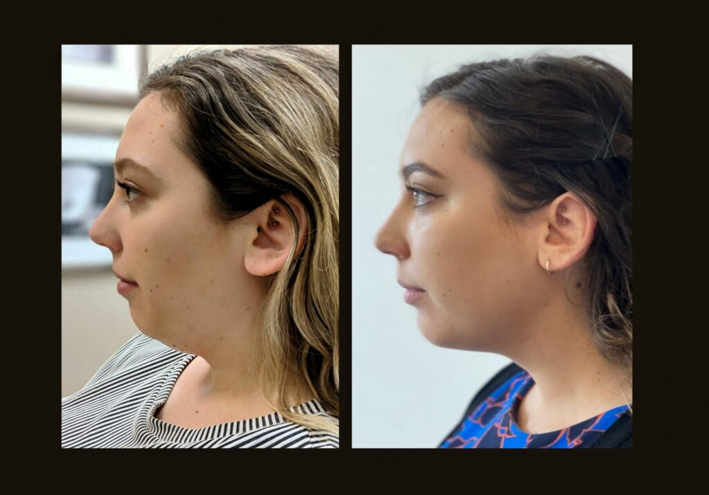 Chin Liposuction Before And After