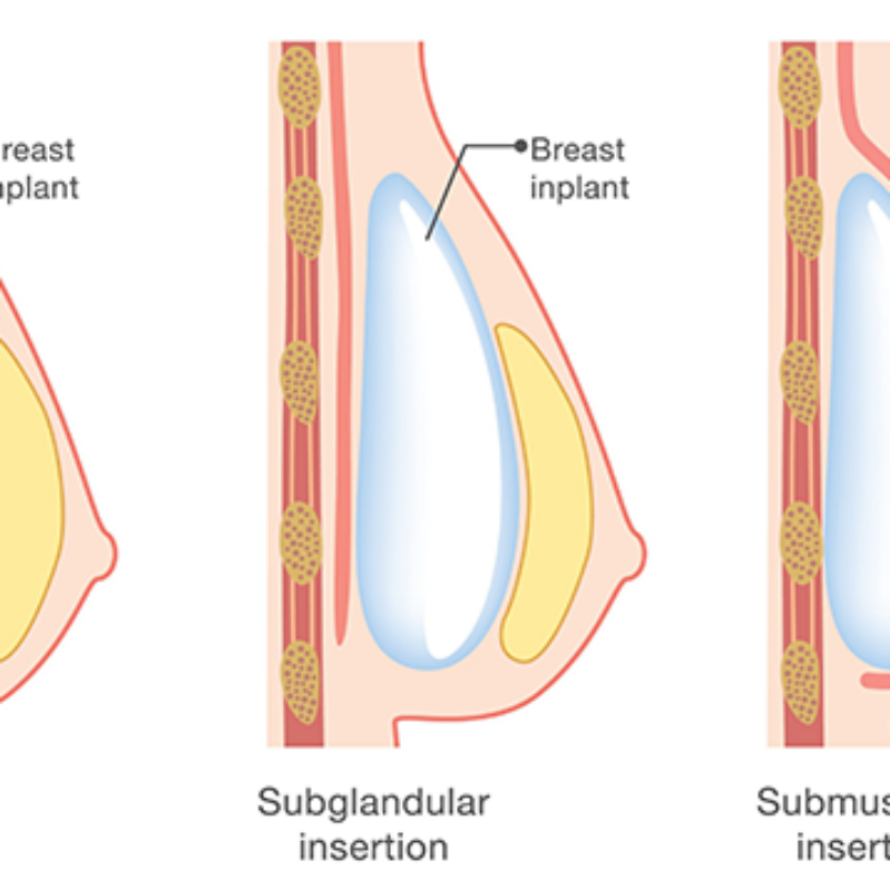 What Is A “Dual Plane” Breast Augmentation?