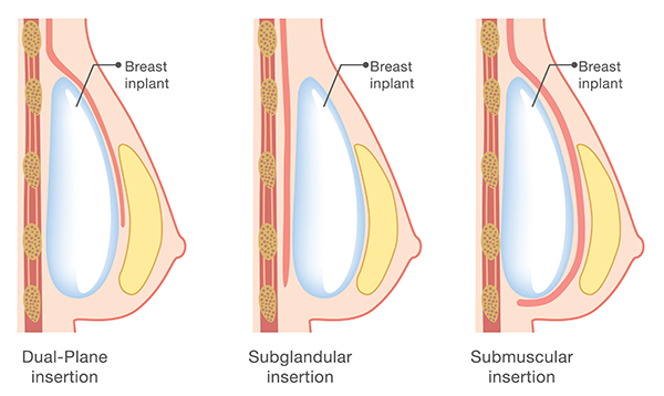 What is a Dual Plane Breast Augmentation?