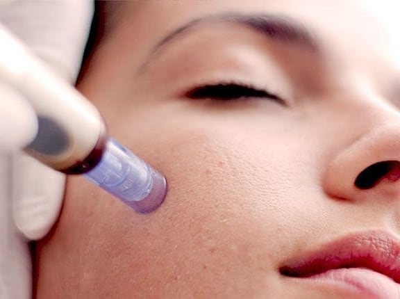 Close Up Of Microneedling Treatment
