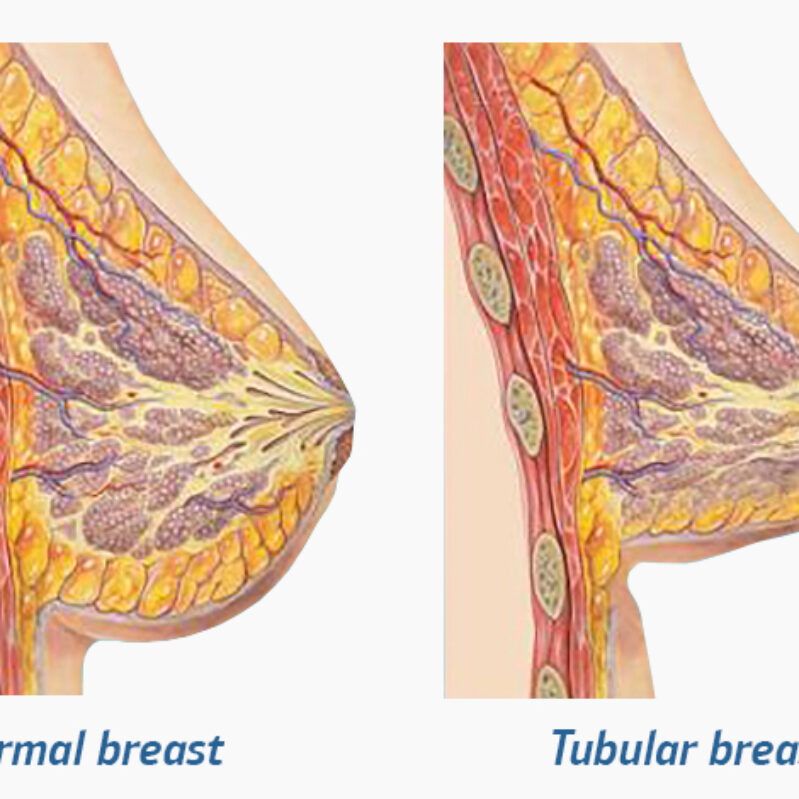 Understanding Tubular Breasts