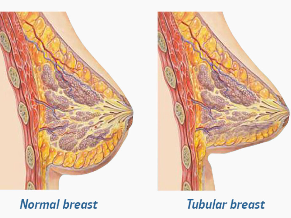 Understanding Tubular Breasts