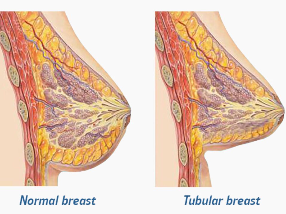 了解管状乳房
