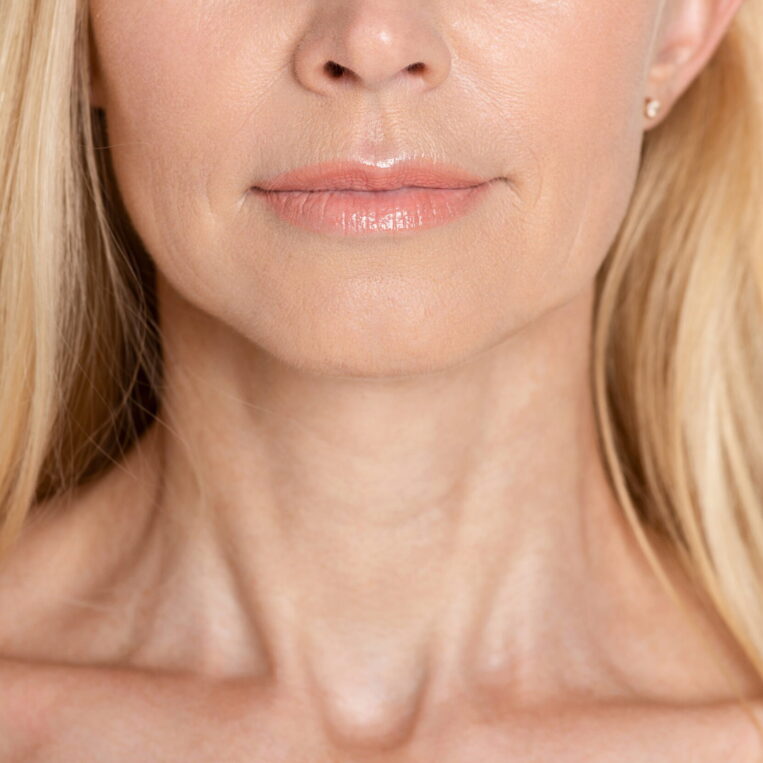 Rhinoplasty with a lip lift procedure