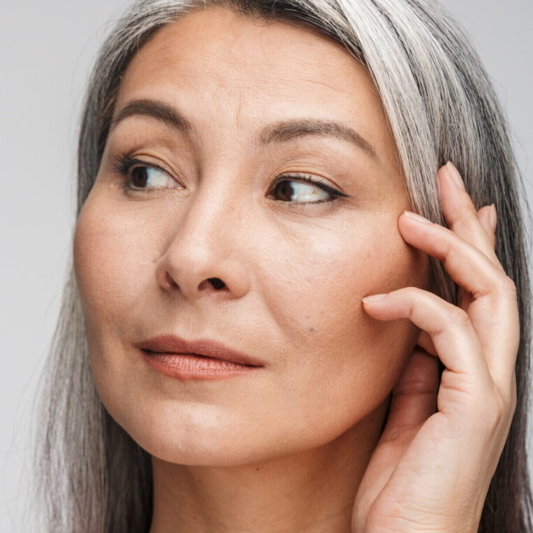 Patient who underwent both blepharoplasty and Botox