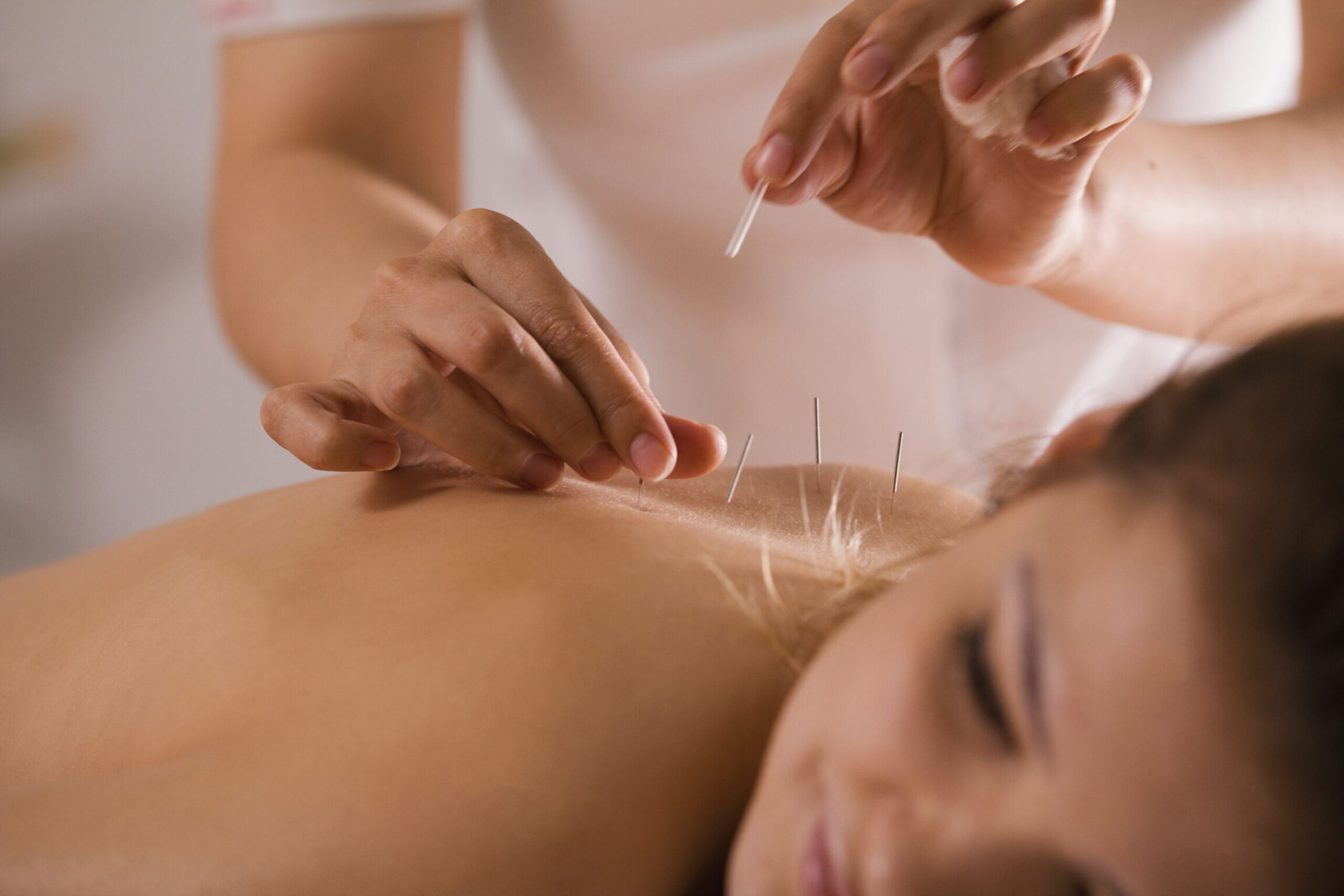 Patient undergoing acupuncture treatment for menopause
