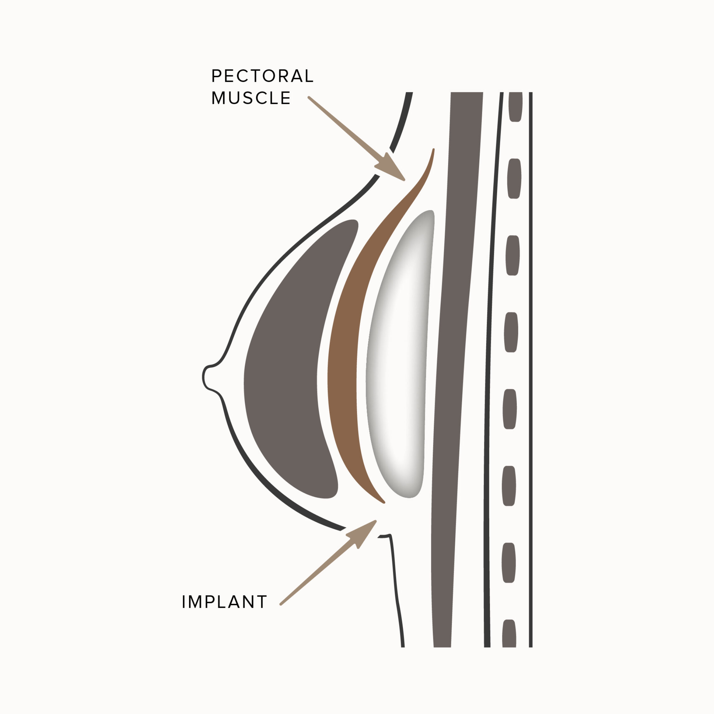Diagram that shows the implant placement of a submuscular breast augmentation