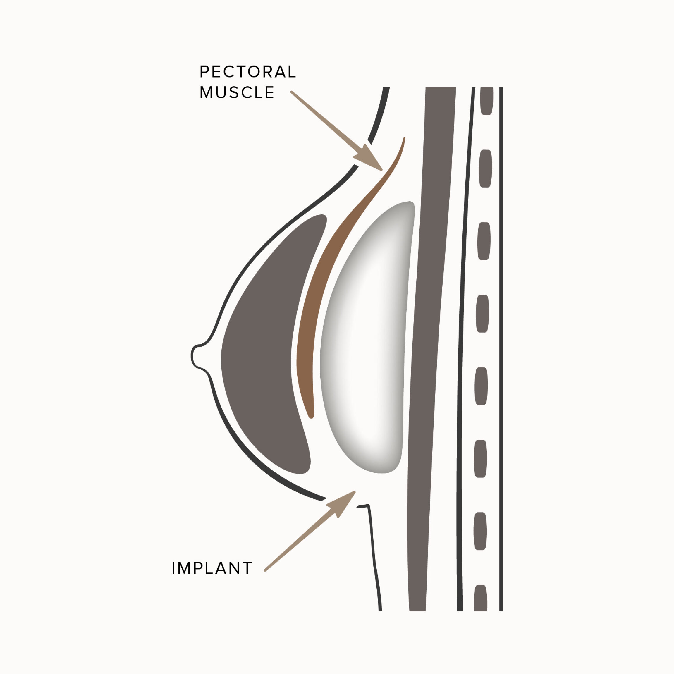 Updated diagram that shows the Dual-Plane Breast Augmentation