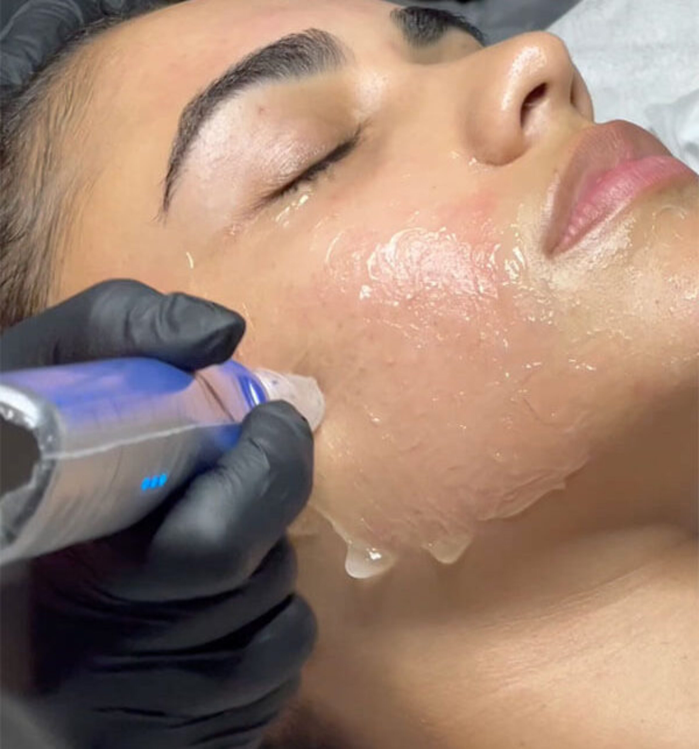 Closeup of SkinPen microneedling after topical numbing has been applied to the skin