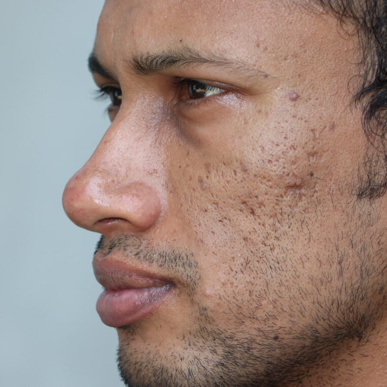 A 30 year old man with deeper acne scars