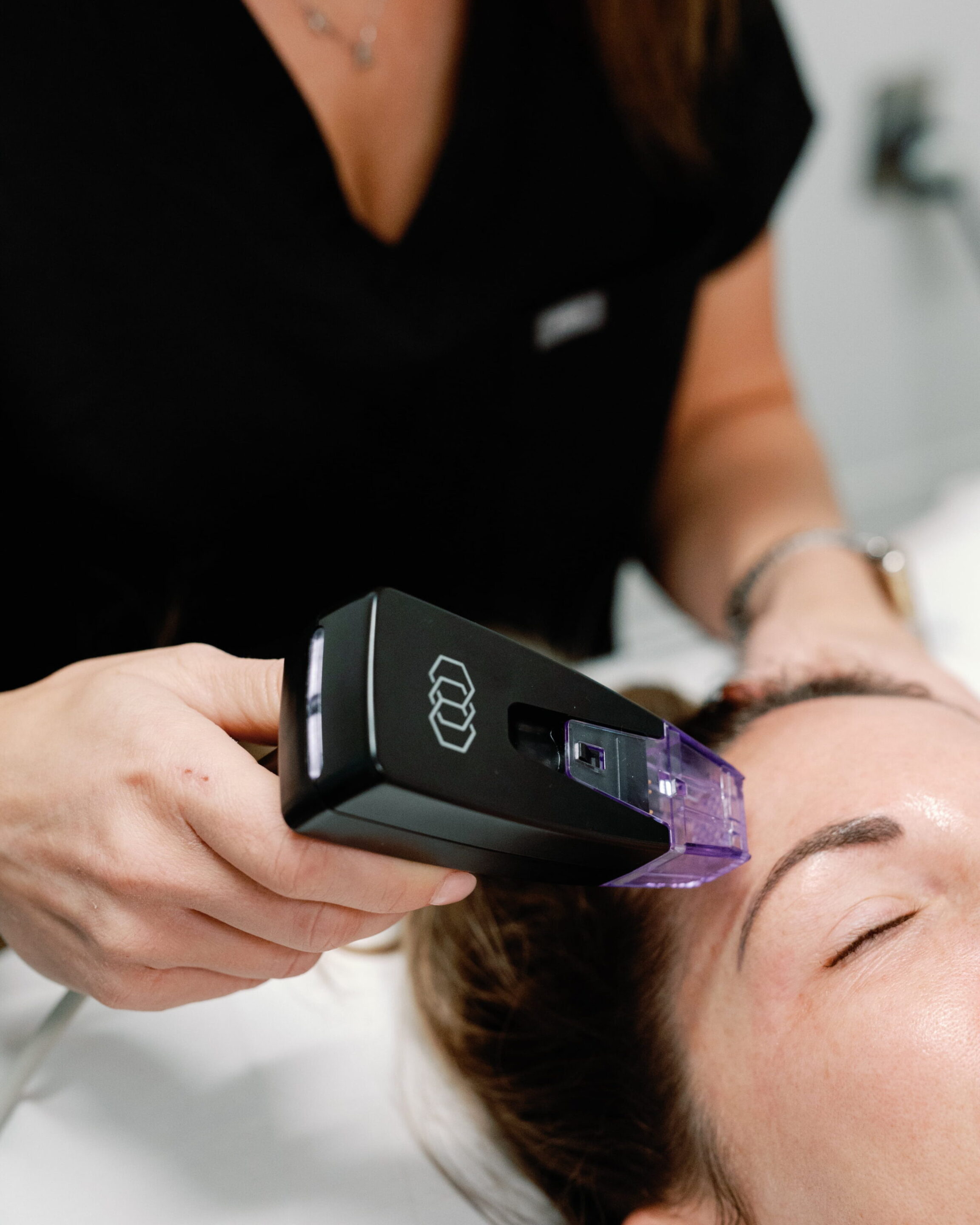 Columbus, Ohio Microneedling patient receiving a treatment at Donaldson