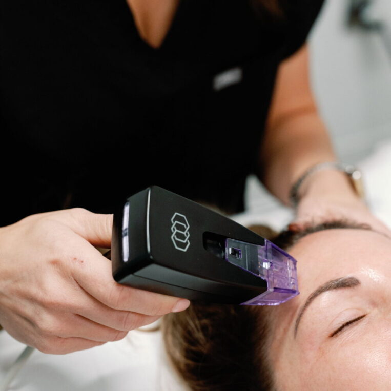 Patient undergoing an in-office Morpheus8 treatment