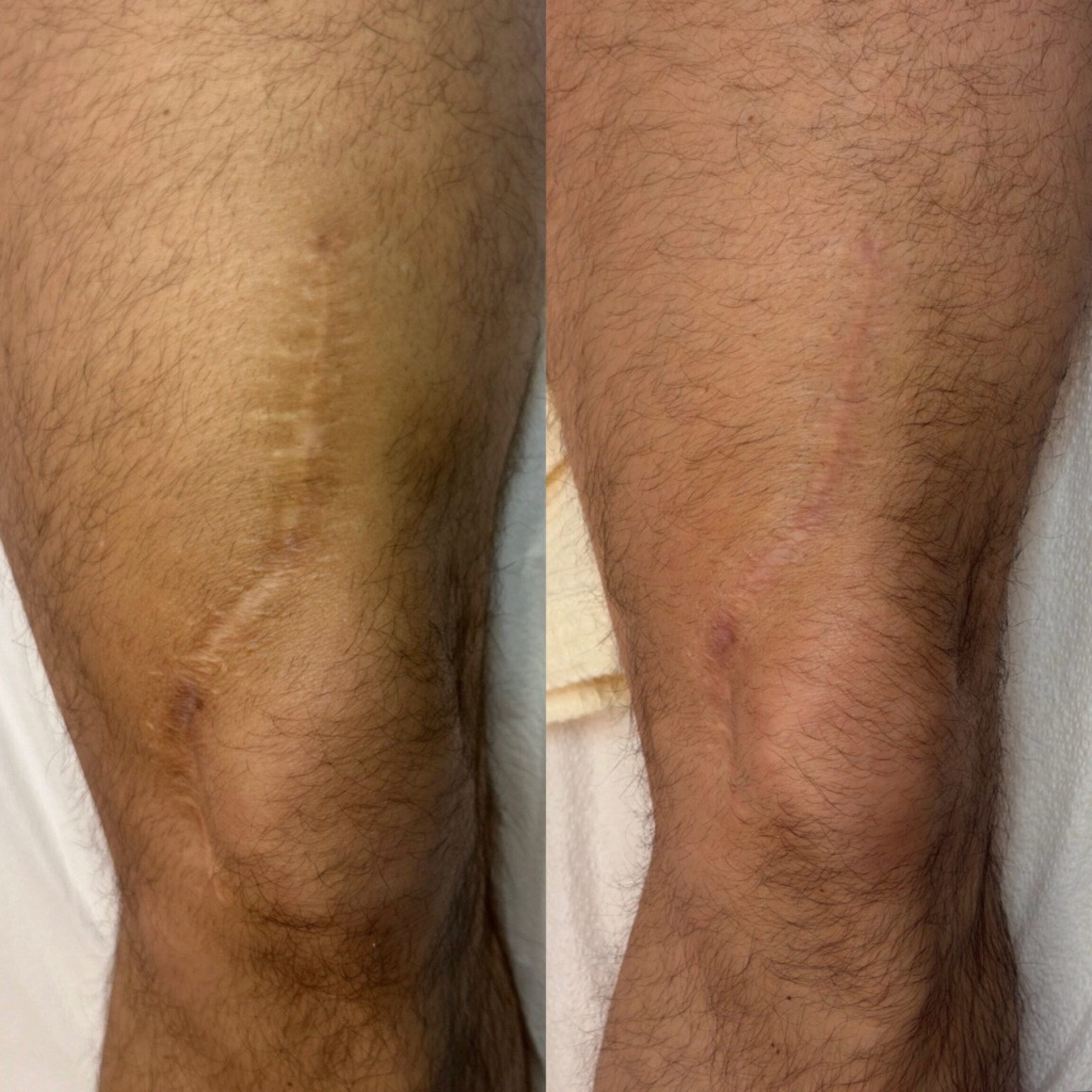Scar camouflage before and after photo, up close of scar mitigation on the knee
