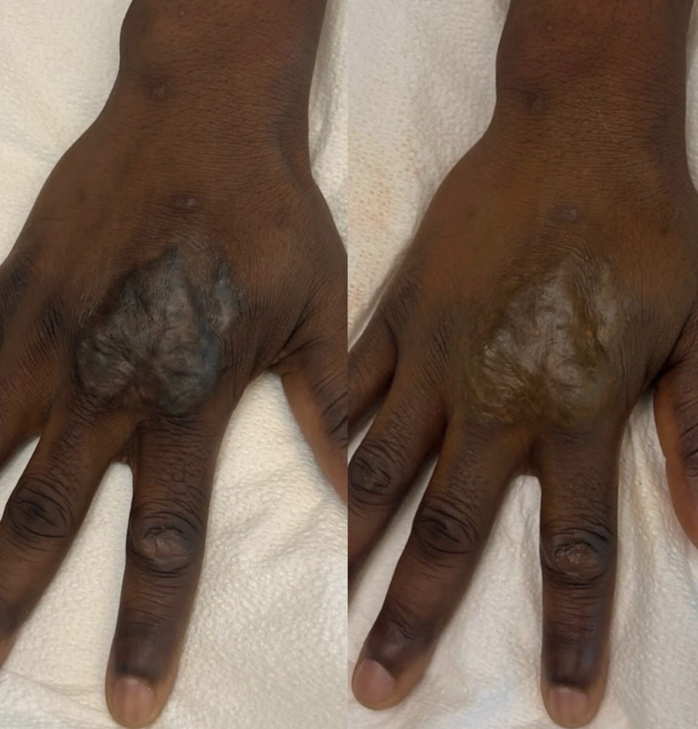 Before and After photo of paramedical tattooing on the hands