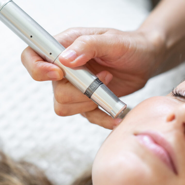 Up-close photo of a microneedling device being used on a Columbus, Ohio patient